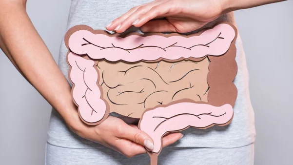 Colorectal cancer graphic of Intestines